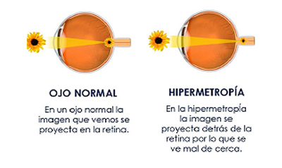 hipermetropia